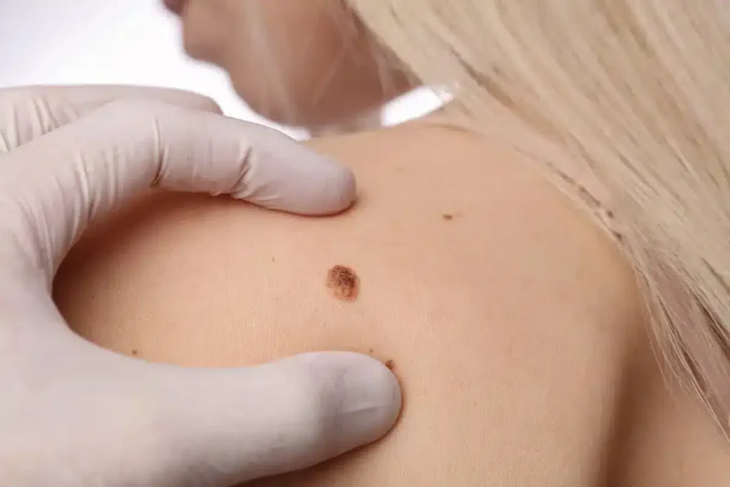 Skin Tag Removal