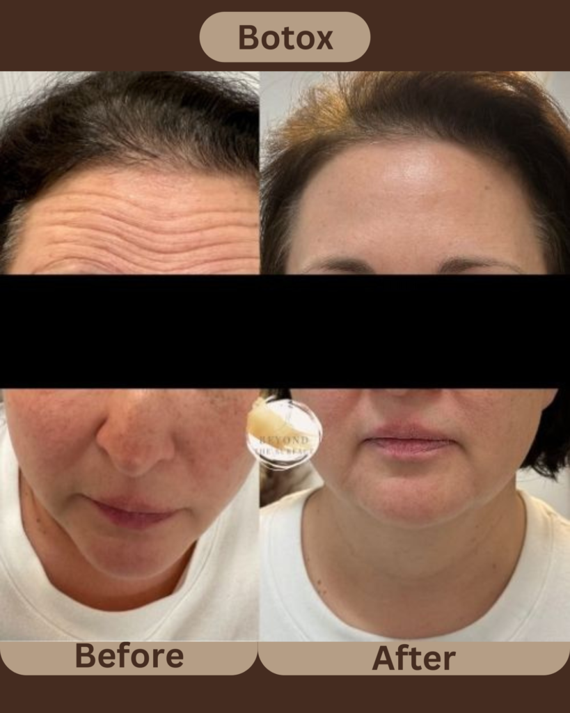 Botox Forehead Transformation at Beyond the Surface