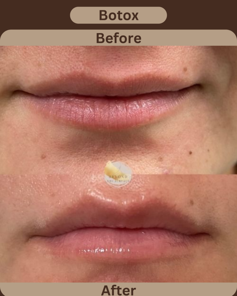 Botox Lip filler at Beyond the Surface Edgewater, NJ