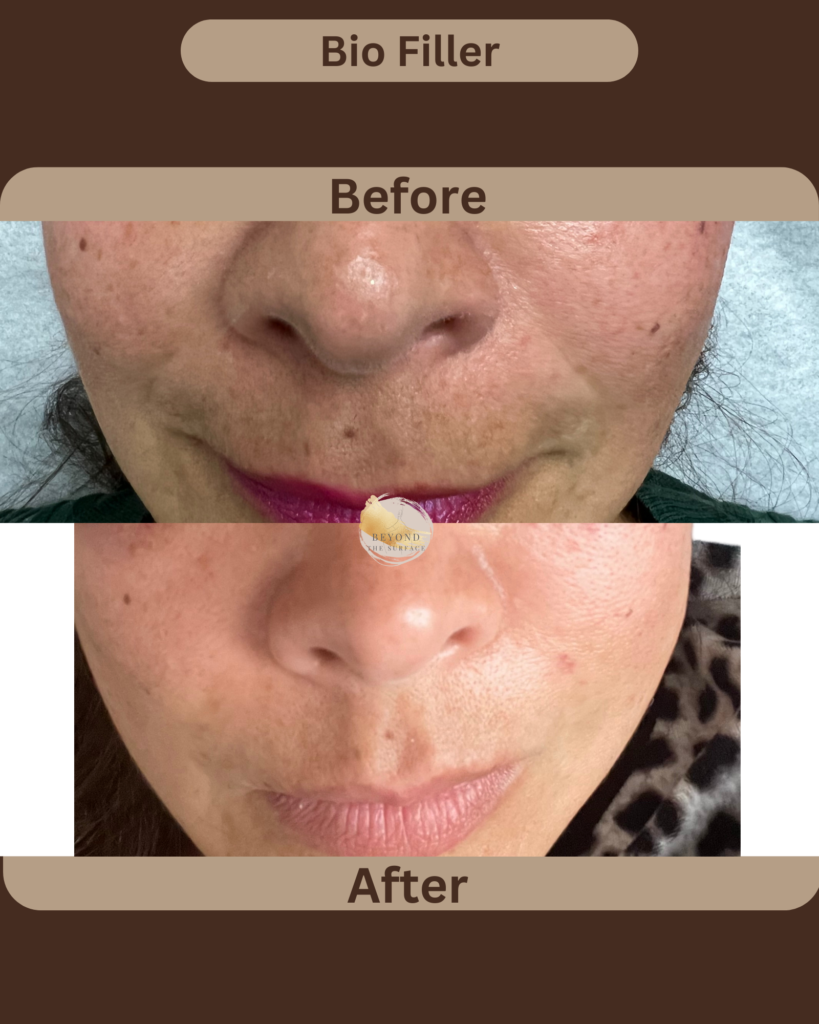 Bio Filler Before and After Treatment