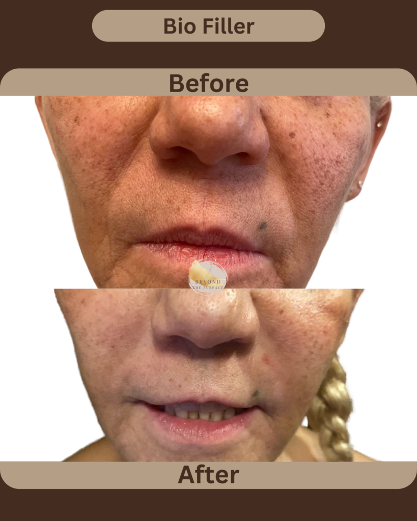 Bio Filler Before and After Treatment Cheek