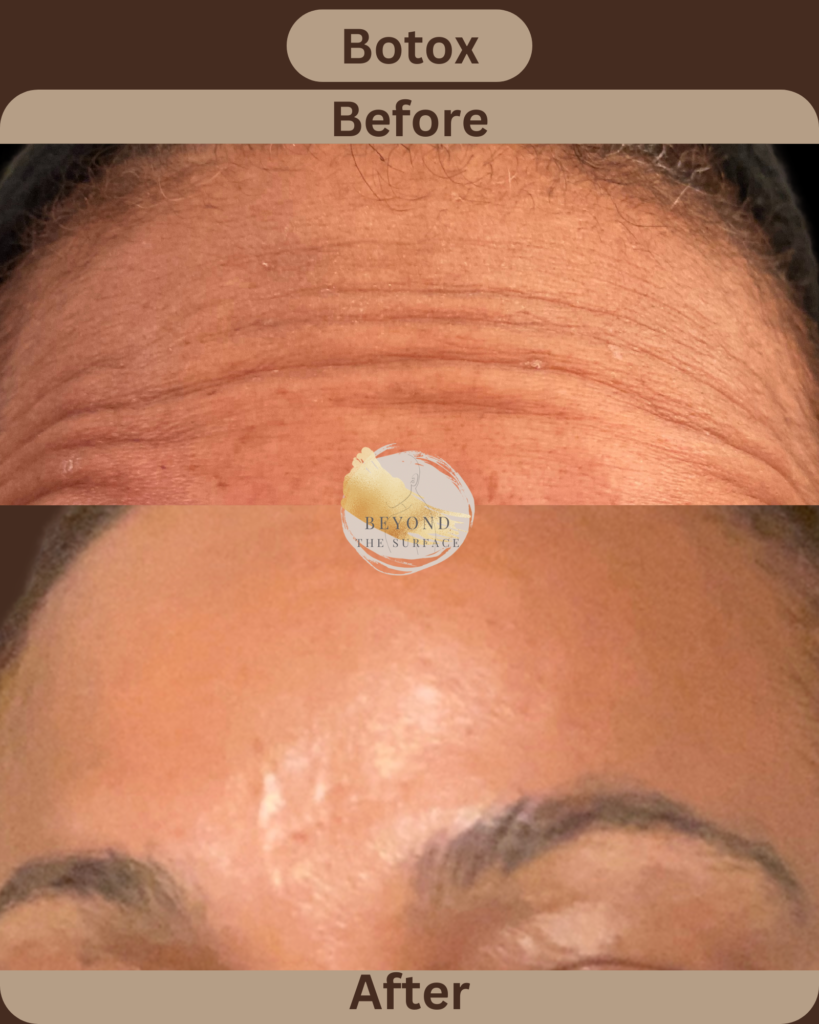 Botox appliance on forehead