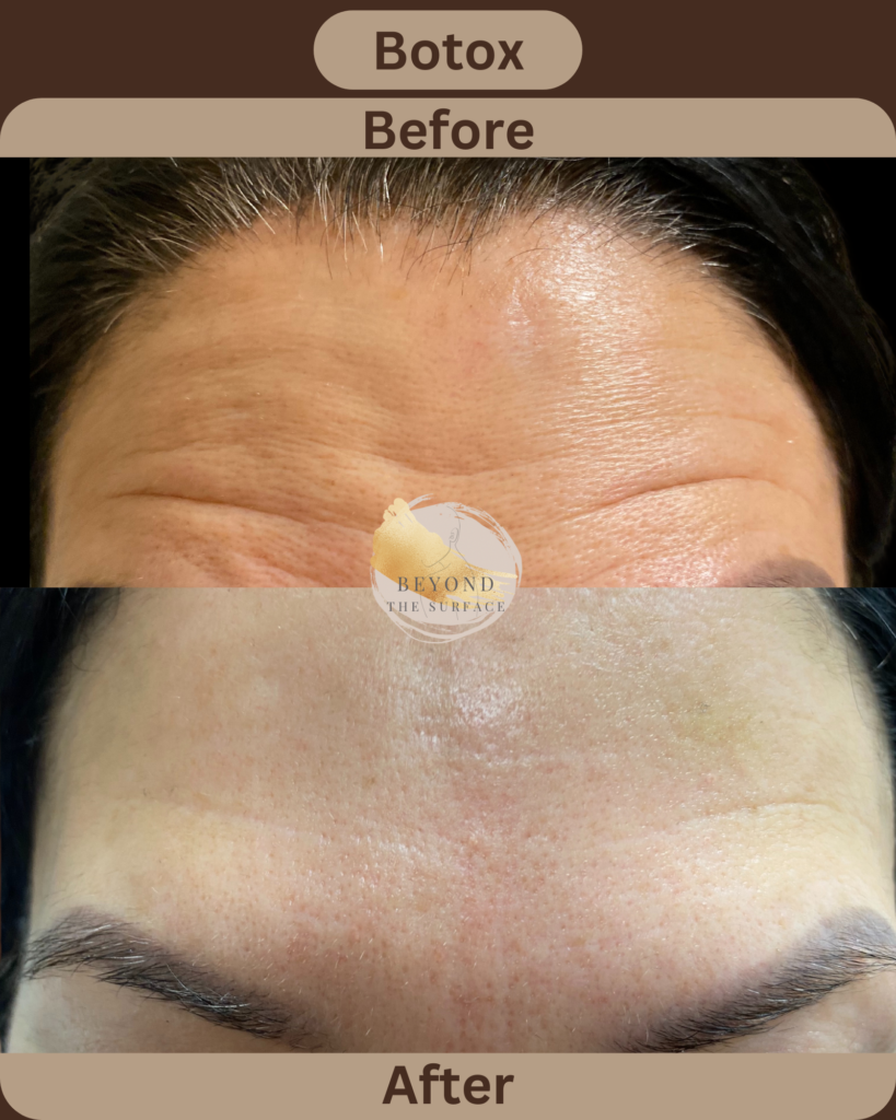 Botox to Frontalis / Forehead