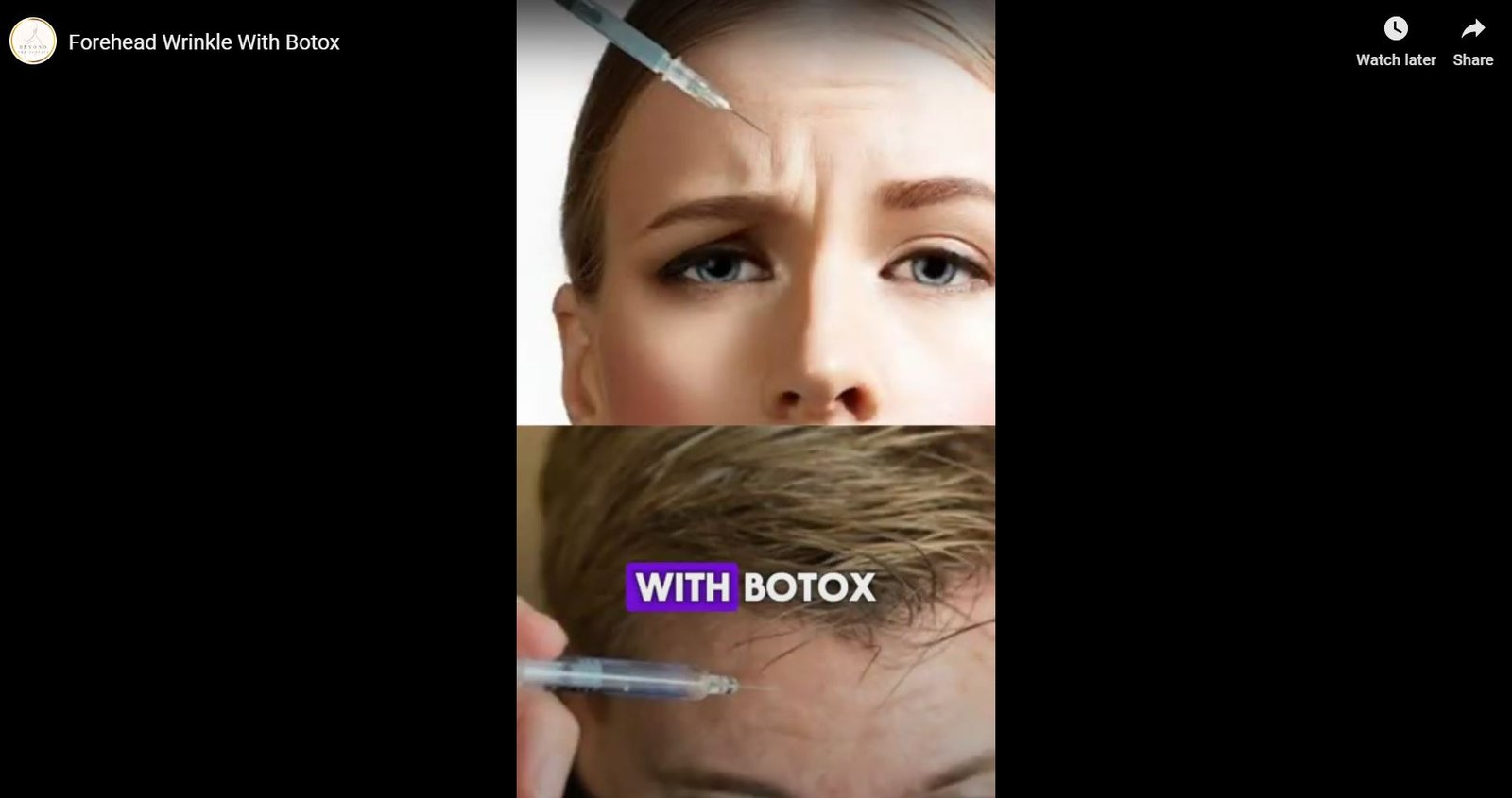 Forehead Wrinkle With Botox