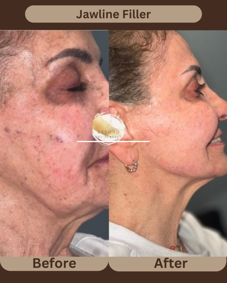 Jawline Filler before after treatment