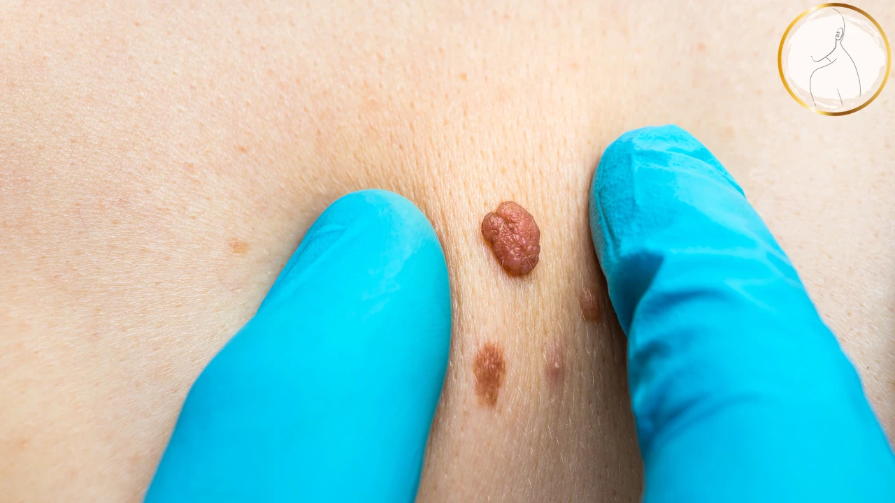 Skin Tag Removal Important
