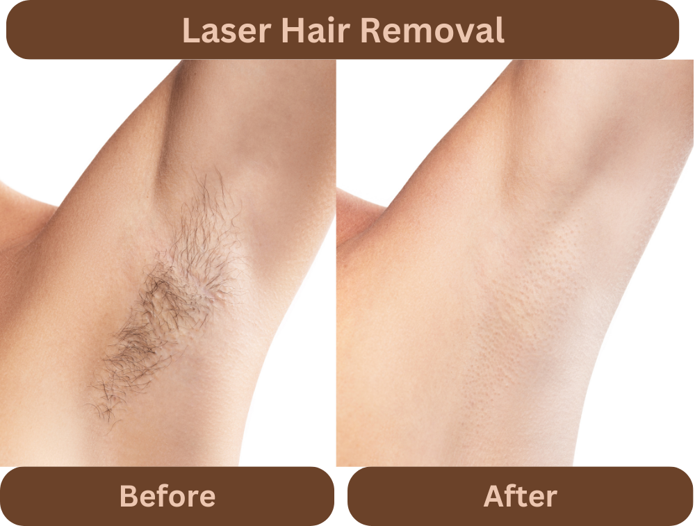 Does laser hair removal remove hair instantly