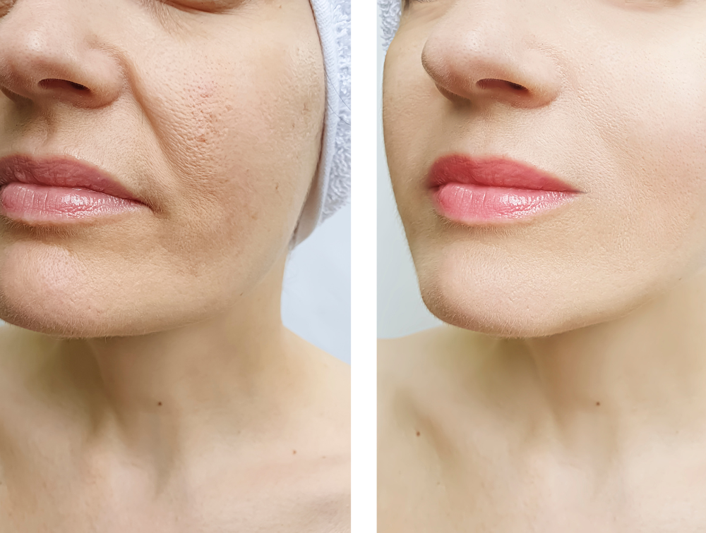 Skin Tightening