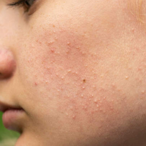 Clogged Pores _ Sebaceous Hyperplasia (raised, yellowish oil gland bumps)