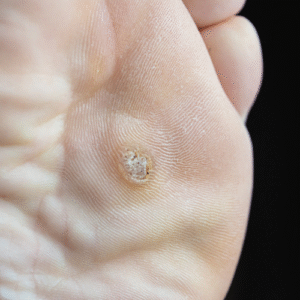 Small Warts (non-genital)