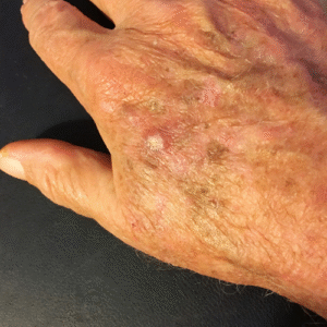Solar Keratoses (Actinic Keratoses) – Only if cleared as benign (not precancerous)
