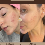 Acne-at-beyond-the-surface-medical -spa-in-Edgewater-before-and-after-result