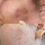 Acne-at-beyond-the-surface-medical -spa-in-Edgewater-before-and-after-result-2