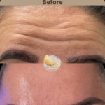 Botox-at-beyond-the-surface-medical -spa-in-Edgewater-before-and-after-result-4