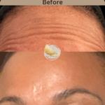 Botox-at-beyond-the-surface-medical -spa-in-Edgewater-before-and-after-result-5