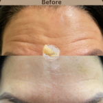 Botox-at-beyond-the-surface-medical -spa-in-Edgewater-before-and-after-result-7