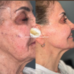 Jawline-filler-at-beyond-the-surface-medical -spa-in-Edgewater-before-and-after-result