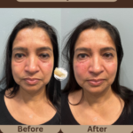 Undereye-filler-at-beyond-the-surface-medical -spa-in-Edgewater-before-and-after-result