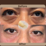 Undereye-filler-at-beyond-the-surface-medical -spa-in-Edgewater-before-and-after-result-2