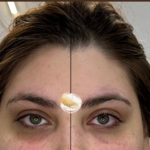Undereye-filler-at-beyond-the-surface-medical -spa-in-Edgewater-before-and-after-result-3