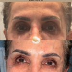 Undereye-filler-at-beyond-the-surface-medical -spa-in-Edgewater-before-and-after-result-4