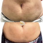 mesotherapy-at-beyond-the-surface-medical -spa-in-Edgewater-before-and-after-result