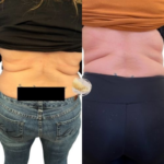 mesotherapy-at-beyond-the-surface-medical -spa-in-Edgewater-before-and-after-result-3