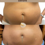 mesotherapy-belly-at-beyond-the-surface-medical -spa-in-Edgewater-before-and-after-result