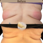 mesotherapy-fatloss-at-beyond-the-surface-medical -spa-in-Edgewater-before-and-after-result