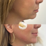 pdo-thread-lift-before-after-results-Edgewater-nj