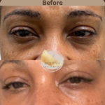 prp-at-beyond-the-surface-medical -spa-in-Edgewater-new-jersey