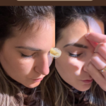 prp-hair-restoration-at-beyond-the-surface-medical -spa-in-Edgewater-new-jersey