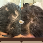 prp-hair-restoration-at-beyond-the-surface-medical -spa-in-Edgewater-new-jersey-2