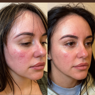 IPL Treatment