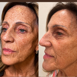 IPL Treatment