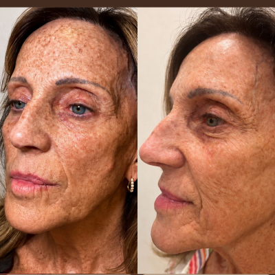 IPL Treatment