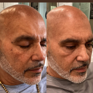 IPL Treatment