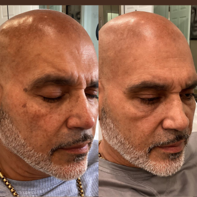 IPL Treatment