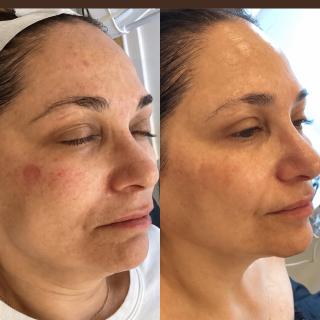 IPL Treatment