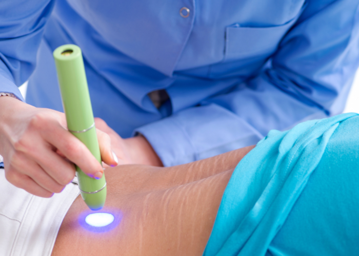 Laser Treatment in strech marks