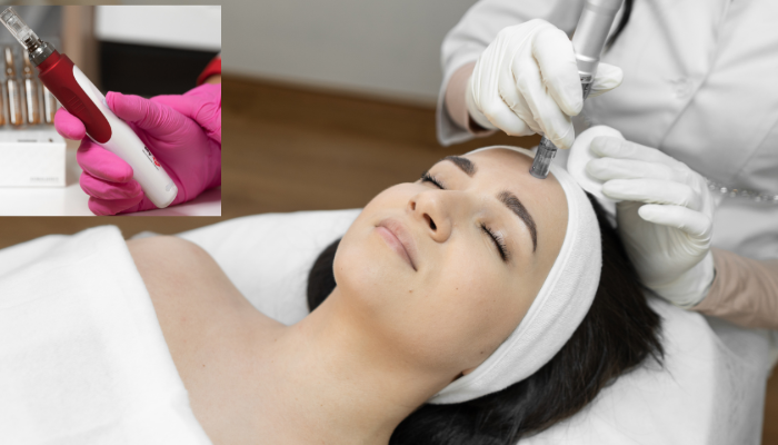 microneedling cost