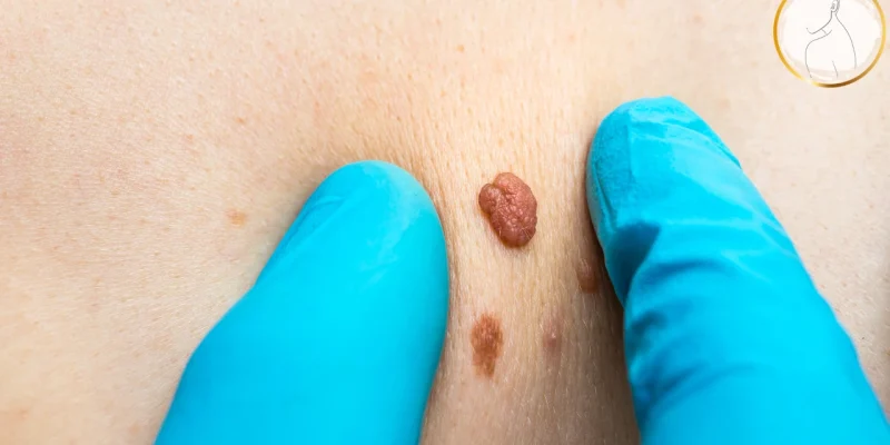 Skin Tag Removal Important